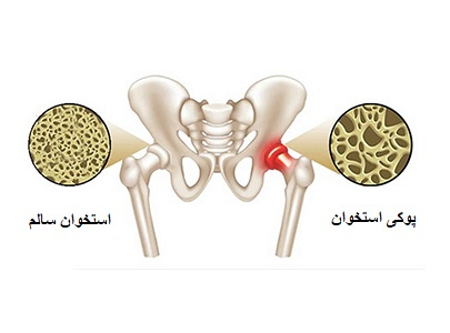 هفته پیشگیری از پوکی استخوان